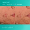 Acne Biotic Moisturizer