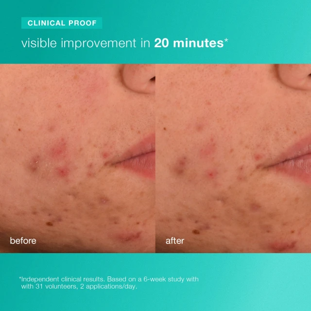 Acne Biotic Moisturizer - 4