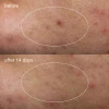 Deep Acne Liquid Patch
